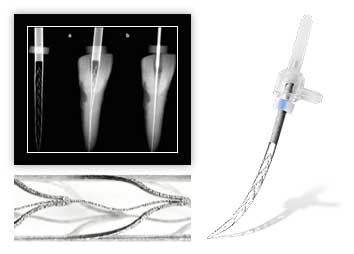 SAF - революция в лечении зубных каналов