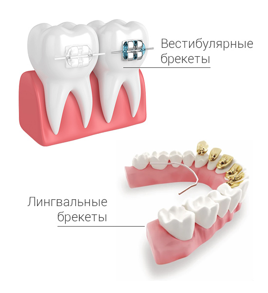 Брекеты в текст.jpg Брекеты в текст.jpg